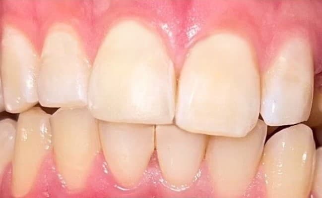 Nahaufnahme von Zähnen nach einer erfolgreichen Parodontose Laser Therapy mit gesundem Zahnfleisch.